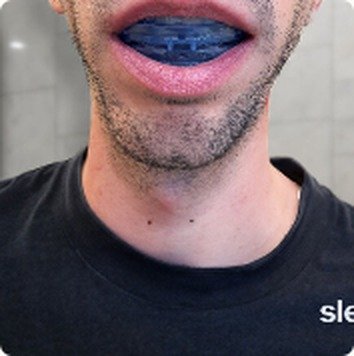 SleepZee warm-water moldable anti-snoring mouthpiece